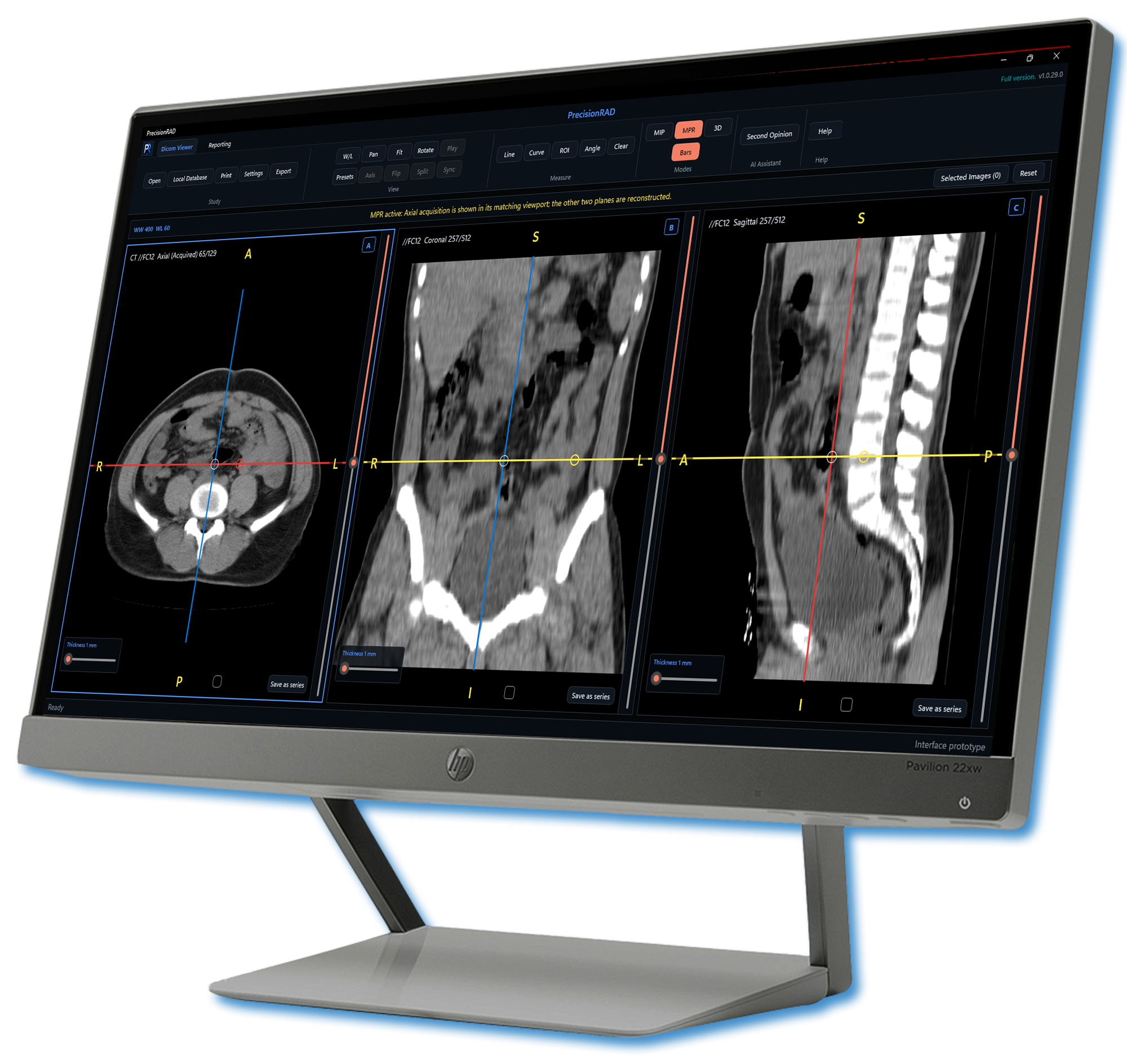 PrecisionRAD MPR workspace showing axial, coronal, and sagittal CT reconstructions